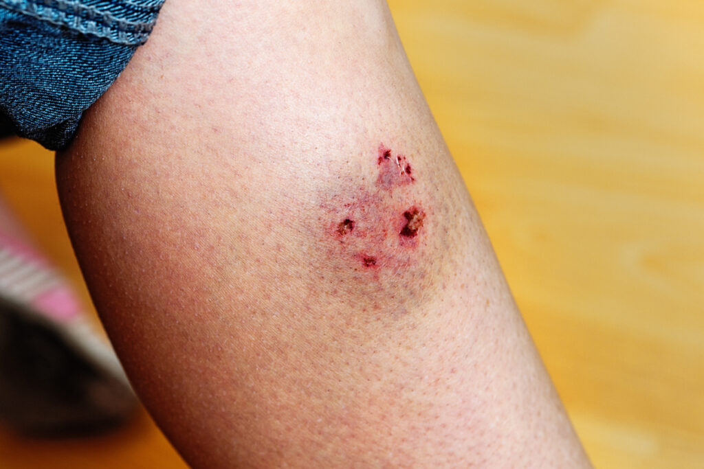 leg-injury-from-dog-bite